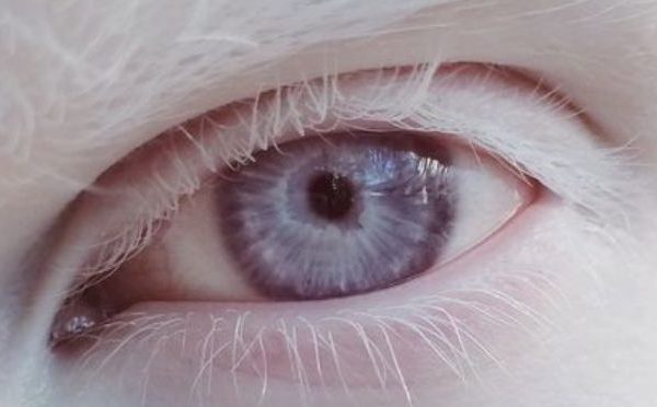 Olho Albino