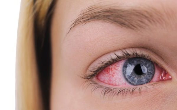 Alergia ocular